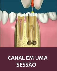 Um de nossos diferenciais é o tratamento de canal em uma sessão