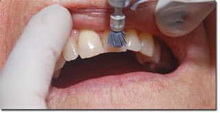 Limpeza Dentária